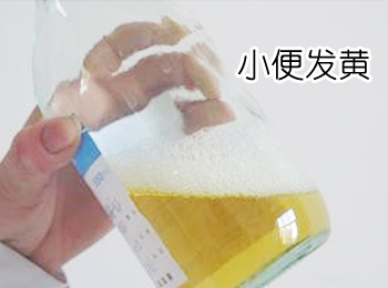 阳江专业治疗小便发黄医院
