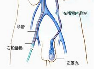精索静脉曲张危害