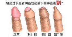 阳江包皮过长