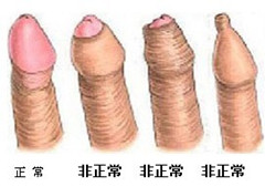 阳江包皮过长的治疗更有效果是哪家