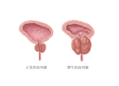 前列腺增生的自检