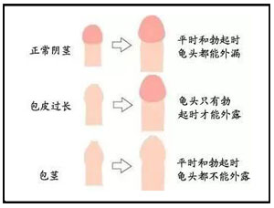 如何治疗包皮？你对包皮手术了解多少